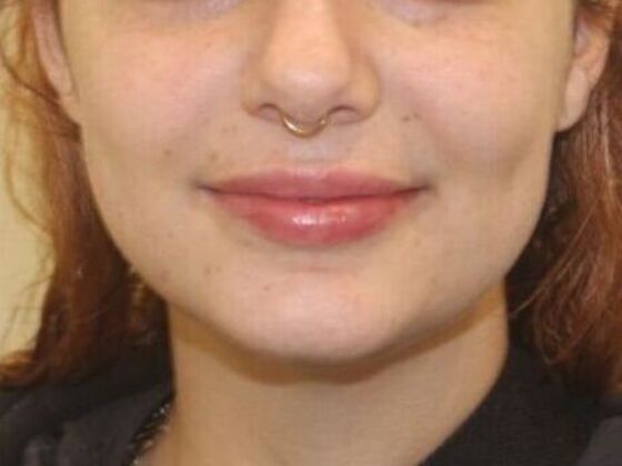 Injectables Case 85 - After