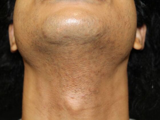 Skin Treatments Case 14 - Before