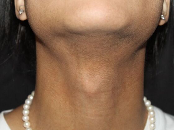 Skin Treatments Case 14 - After