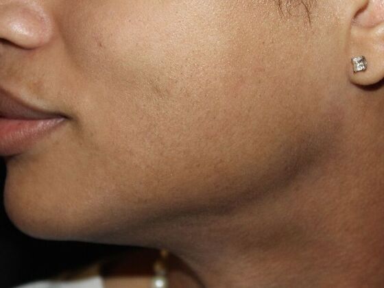 Skin Treatments: Case 14 - After