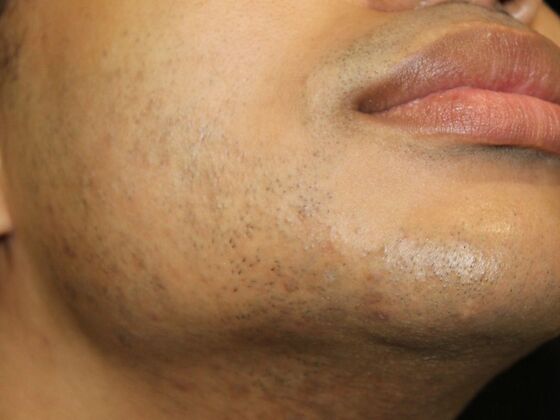 Skin Treatments: Case 14 - Before