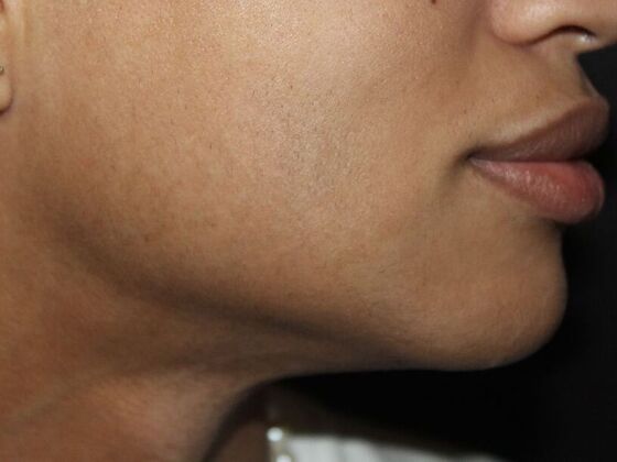 Skin Treatments: Case 14 - After