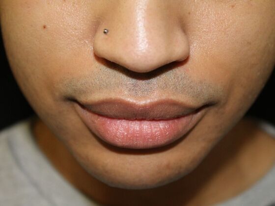 Skin Treatments: Case 14 - Before