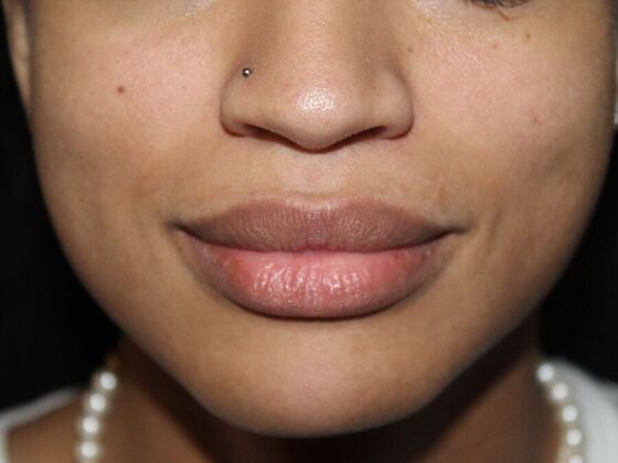 Skin Treatments: Case 14 - After