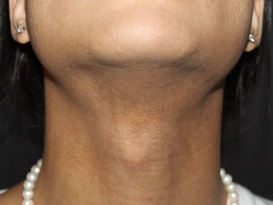 Skin Treatments: Case 14 - After