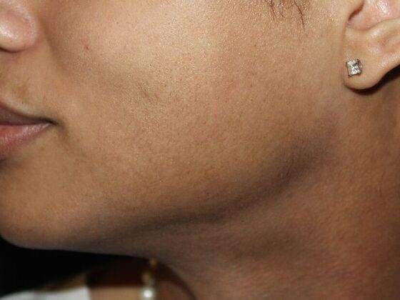 Skin Treatments: Case 14 - After