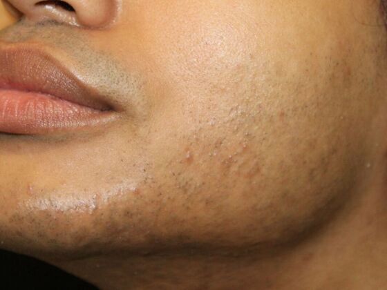 Skin Treatments: Case 14 - Before