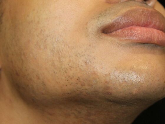 Skin Treatments: Case 14 - Before