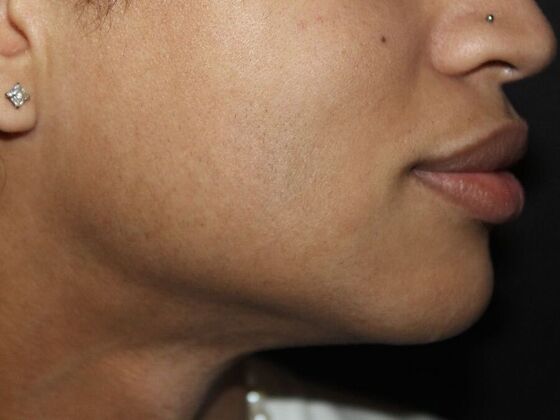 Skin Treatments: Case 14 - After