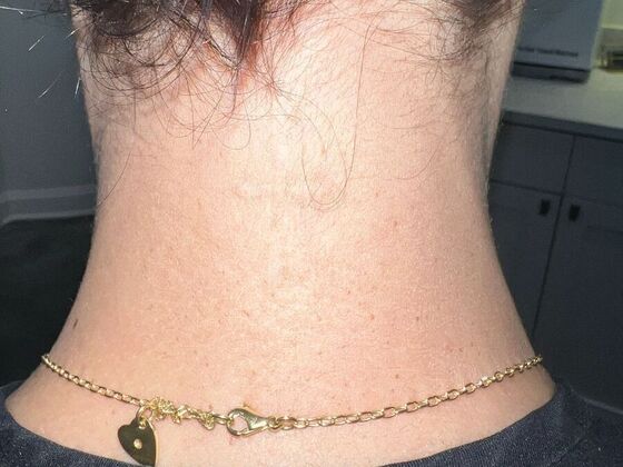 Laser Tattoo Removal Case 39 - After