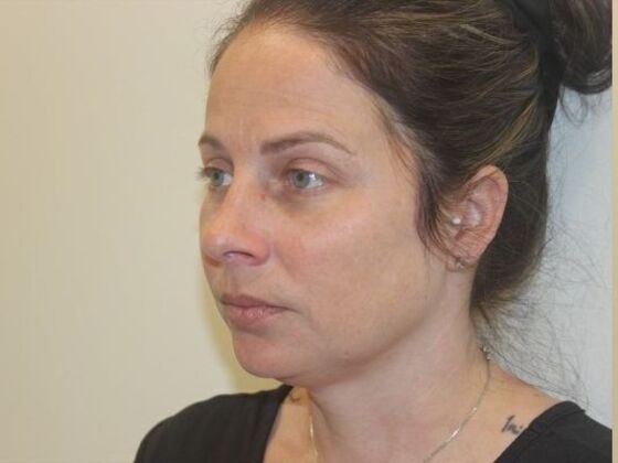 Injectables Case 86 - Before