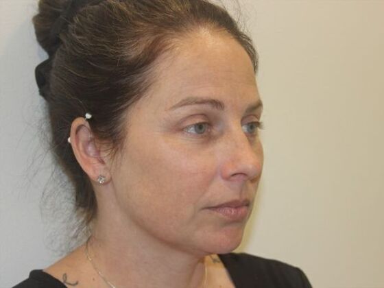 Injectables: Case 86 - Before