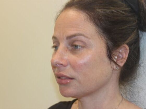 Injectables Case 86 - After