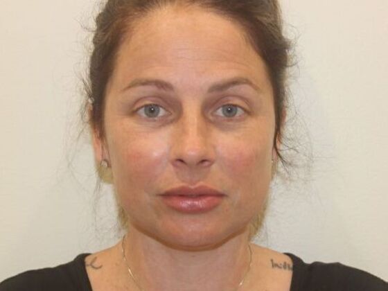 Injectables: Case 86 - After