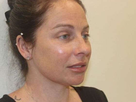 Injectables: Case 86 - After