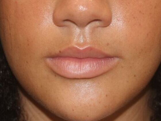 Injectables Case 87 - Before