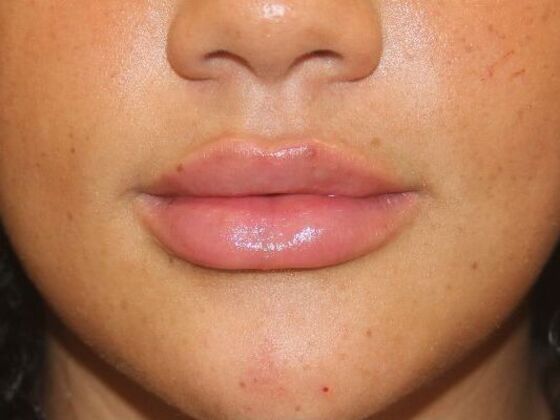 Injectables Case 87 - After