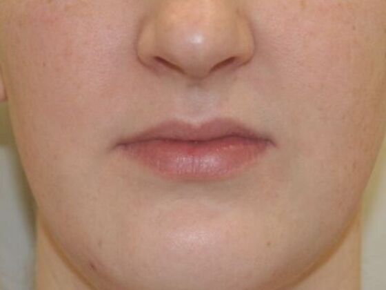 Injectables Case 88 - Before