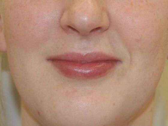 Injectables Case 88 - After