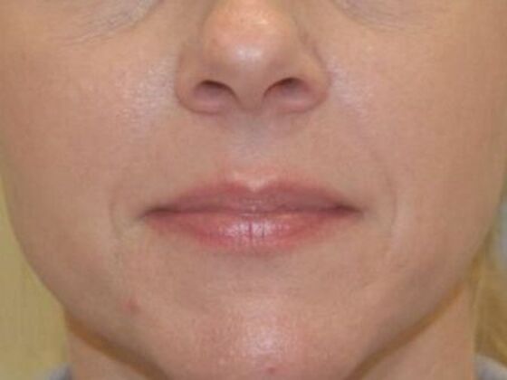 Injectables Case 89 - Before