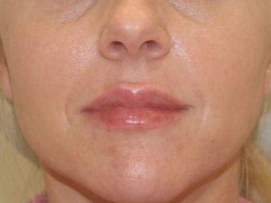 Injectables Case 89 - After