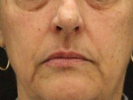 Injectables Case 90 - Before