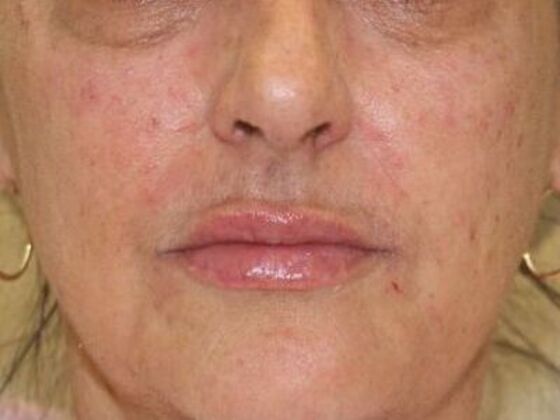 Injectables Case 90 - After