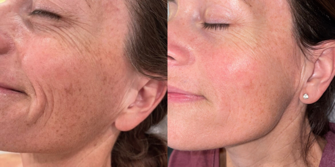Skin Treatments Case 15 - Before