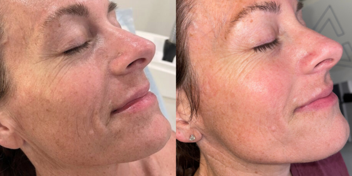 Skin Treatments: Case 15 - After