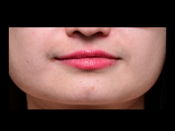 Cosmetic Injectables & Fillers Lip Filler - Before