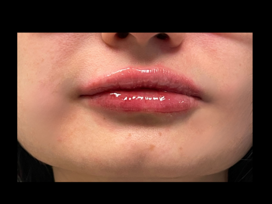Cosmetic Injectables & Fillers Lip Filler - After