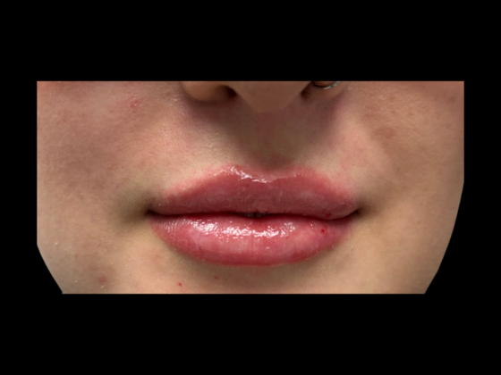 Cosmetic Injectables & Fillers Lip Filler Restylane Kysse - After