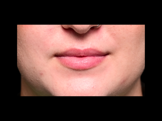 Cosmetic Injectables & Fillers Lip Filler Restylane Kysse - Before
