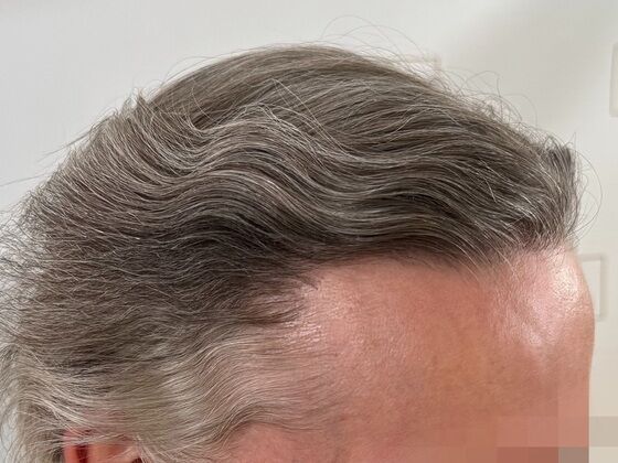 FUE Hair Restoration: Case 43 - After