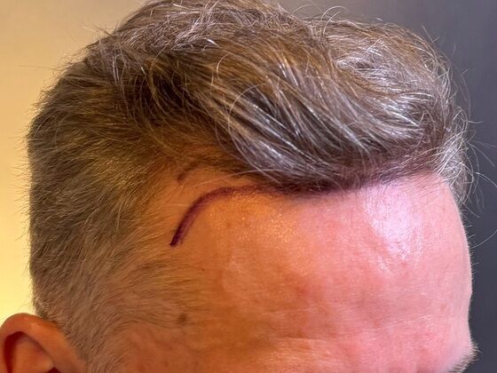 FUE Hair Restoration: Case 43 - Before