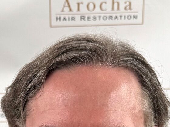FUE Hair Restoration: Case 43 - After