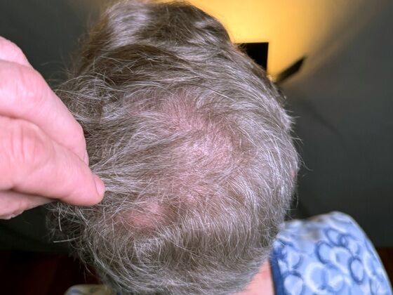 FUE Hair Restoration: Case 43 - Before