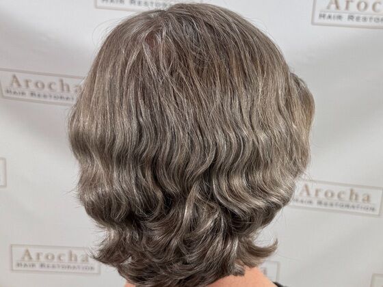 FUE Hair Restoration: Case 43 - After