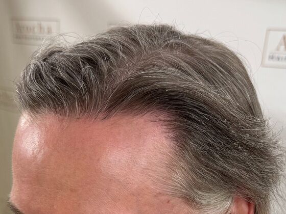 FUE Hair Restoration: Case 43 - After