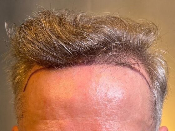 FUE Hair Restoration: Case 43 - Before