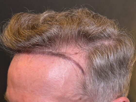 FUE Hair Restoration: Case 43 - Before