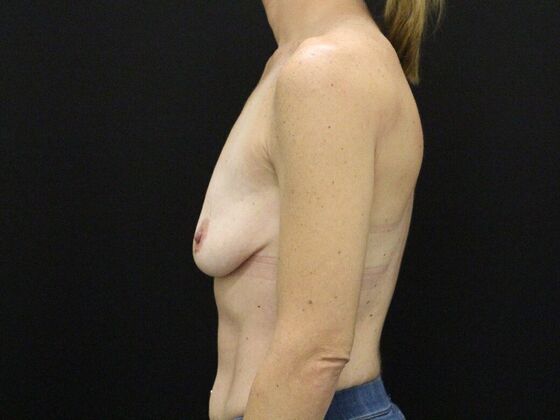 Breast Lift & Breast Lift Augmentation: Case 48 - Before