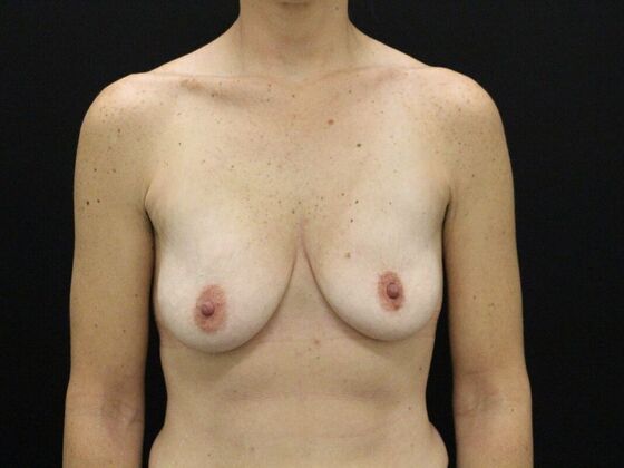 Breast Lift & Breast Lift Augmentation Case 48 - Before