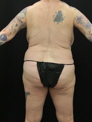 Tummy Tuck: Case 63 - Before