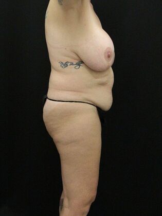 Tummy Tuck: Case 63 - Before