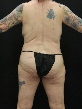 Tummy Tuck: Case 63 - After