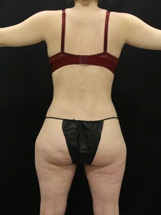 Liposuction Case 53 - After