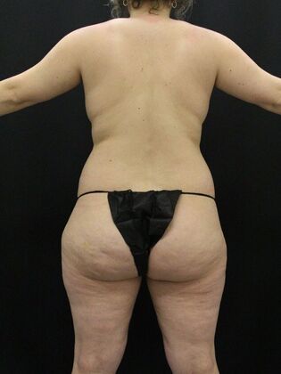 Liposuction Case 53 - Before