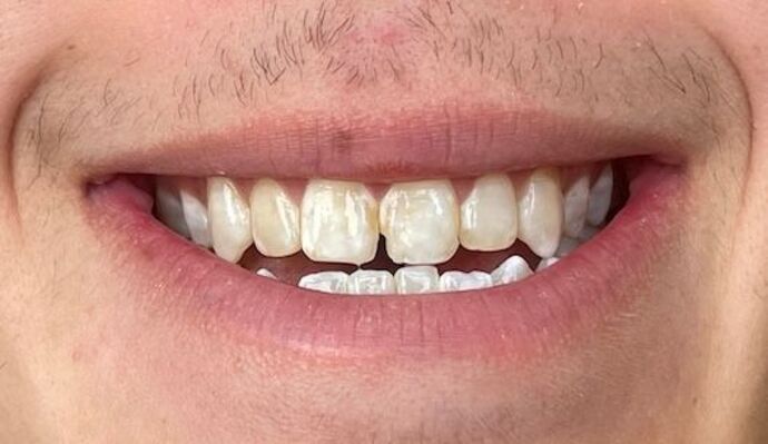 Porcelain Veneers: Case 38 - Before