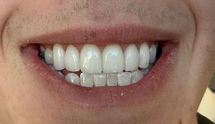 Smile Makeovers: Case 27 - After